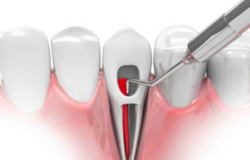 root canal Centreville