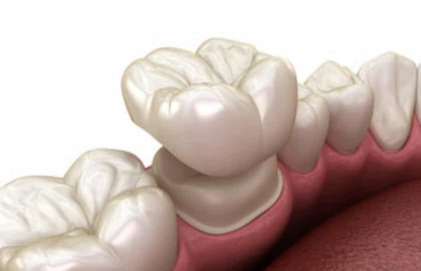 dental crown Centreville