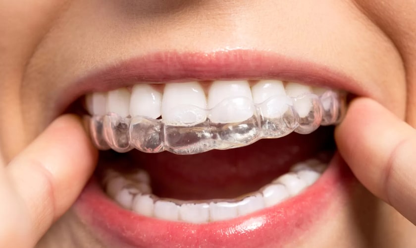 Invisalign Treatment - Centreville Family and cosmetic dentistry