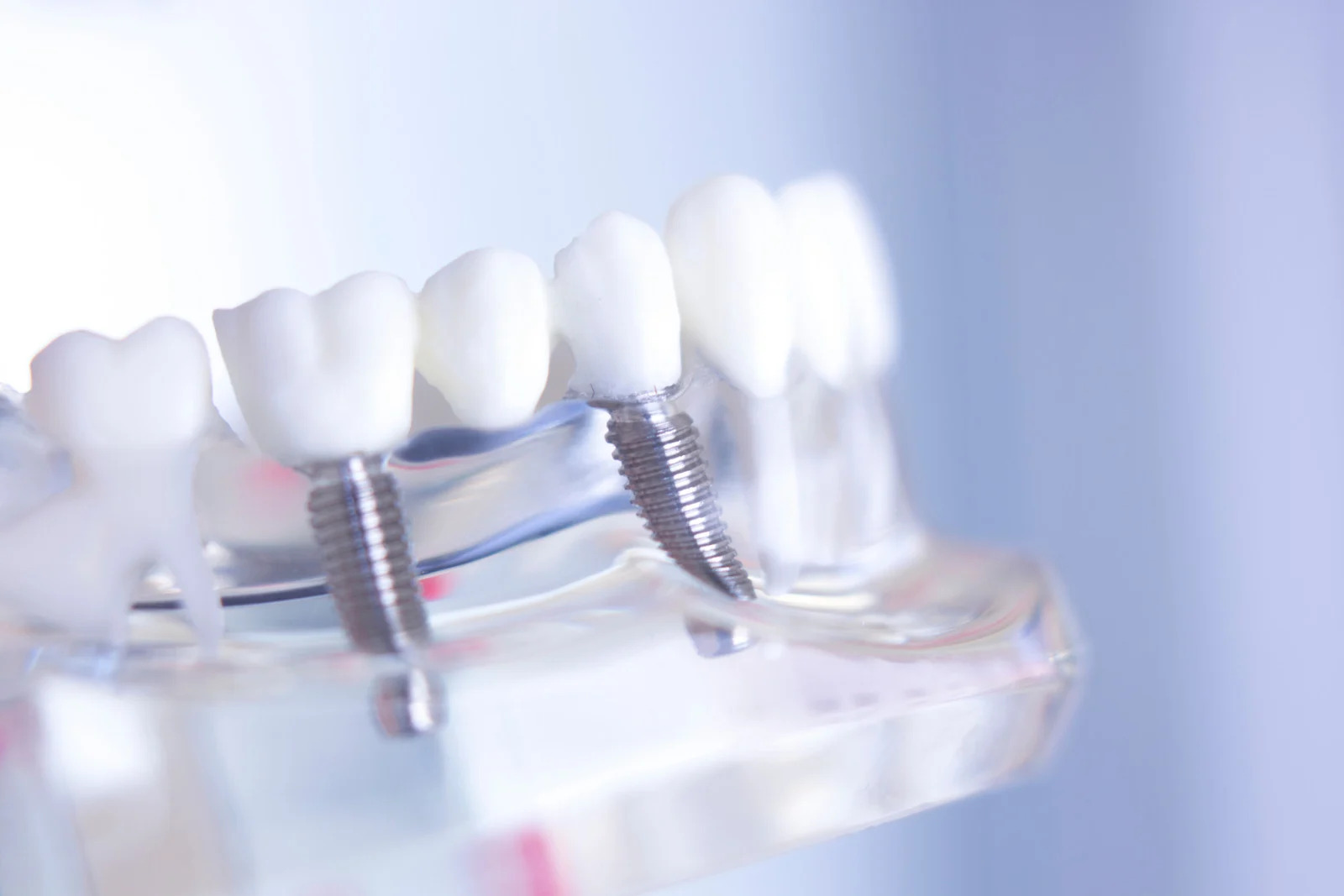 dental implant in centreville va, centreville family and cosmetic dentistry