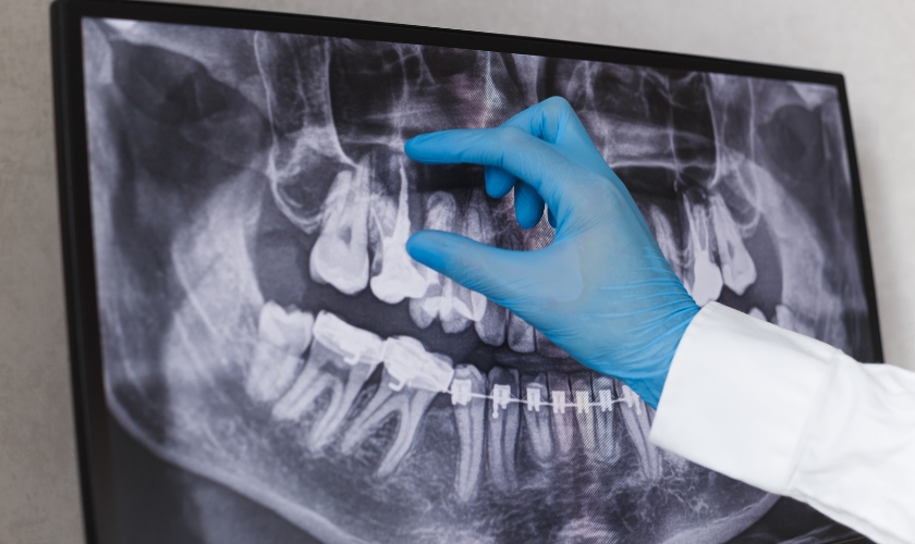 Root Canal Therapy in Centreville, VA