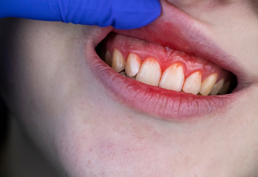 when bleeding gums are considered a dental emergency