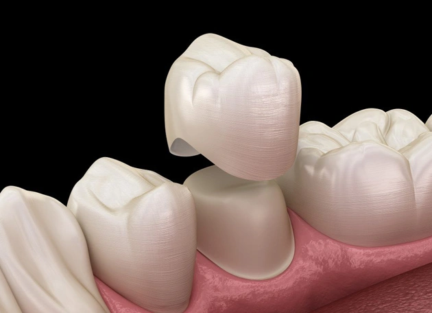 porcelain crowns in centreville