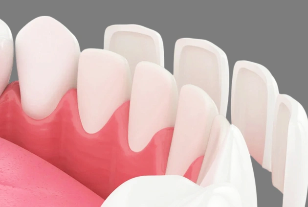 porcelain veneers in centreville