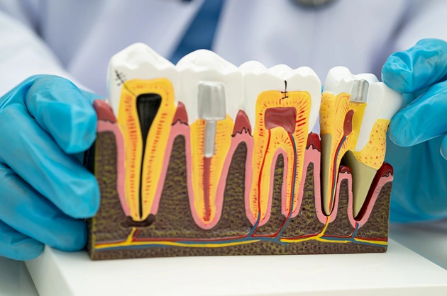 root canal treatment in centreville
