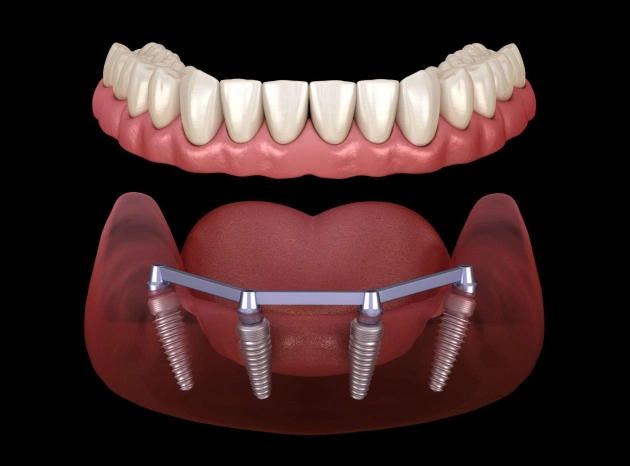all-on-4-implants in centreville, va