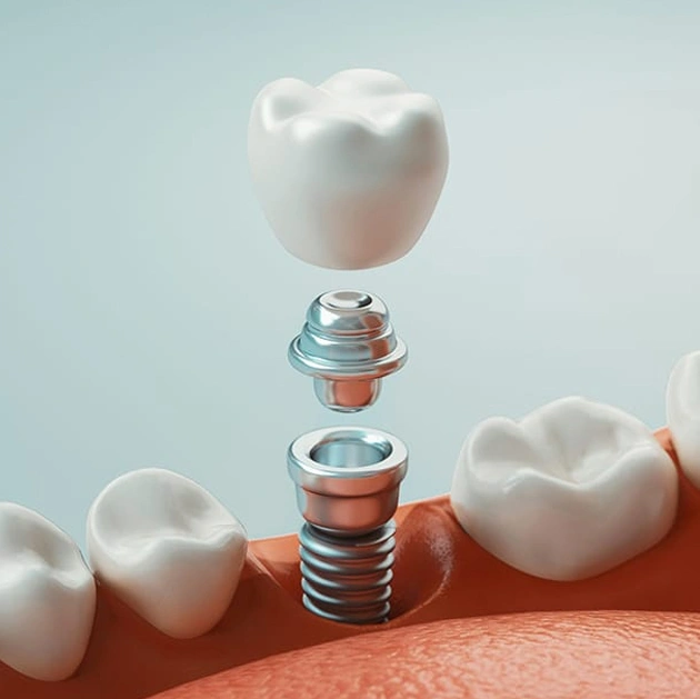 cost of dental implants in centreville, va