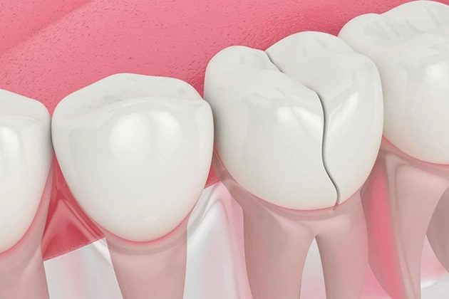 fix chipped, cracked or fractured teeth in centreville, va