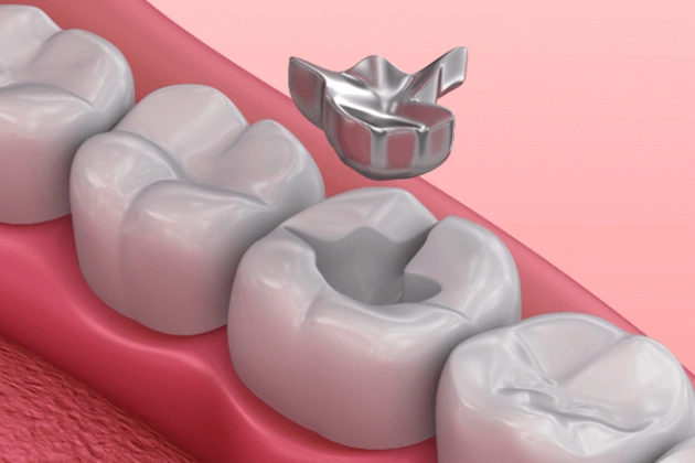 missing or damaged teeth filling in centreville, va