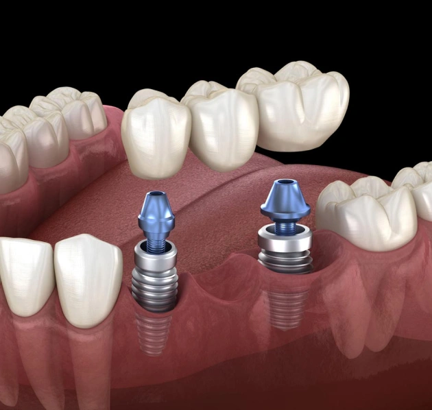 single tooth implants bridges in centreville, va