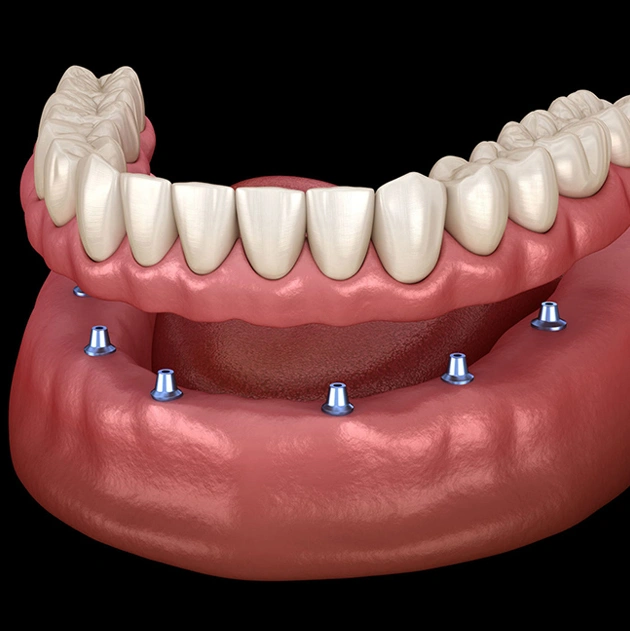 snap in implant dentures in centreville, va