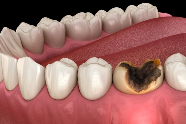 tooth abscess treatment in centreville, va