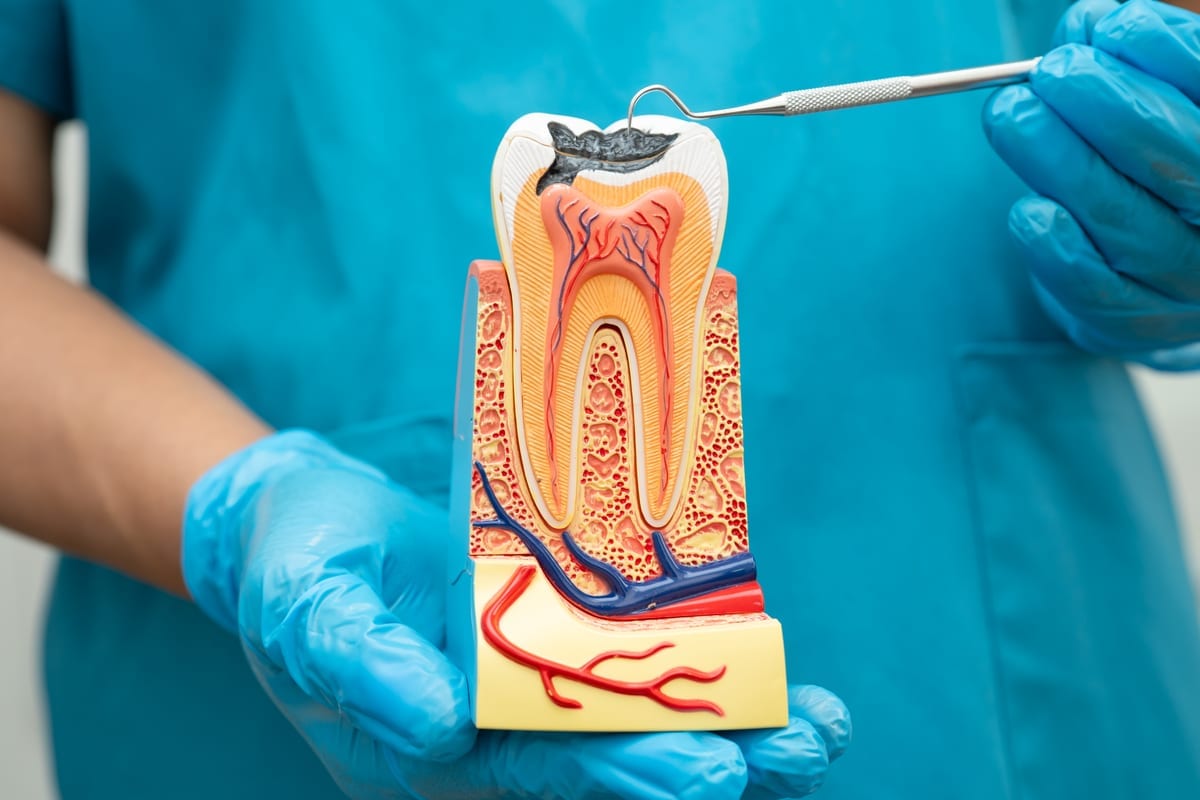 Root Canal Treatment in Centreville
